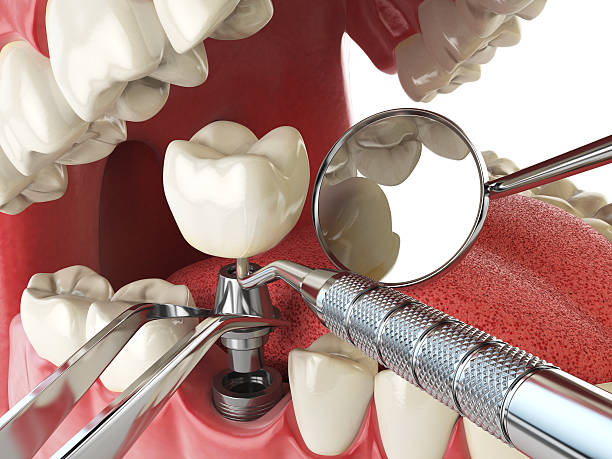 Best Emergency Tooth Extraction in Kootenai, ID
